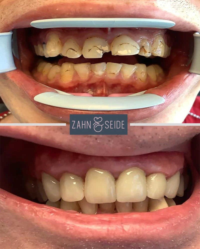 Vorher-Nachher-prothetische-Zahnbehndlung-Zahnarzt-Kerpen