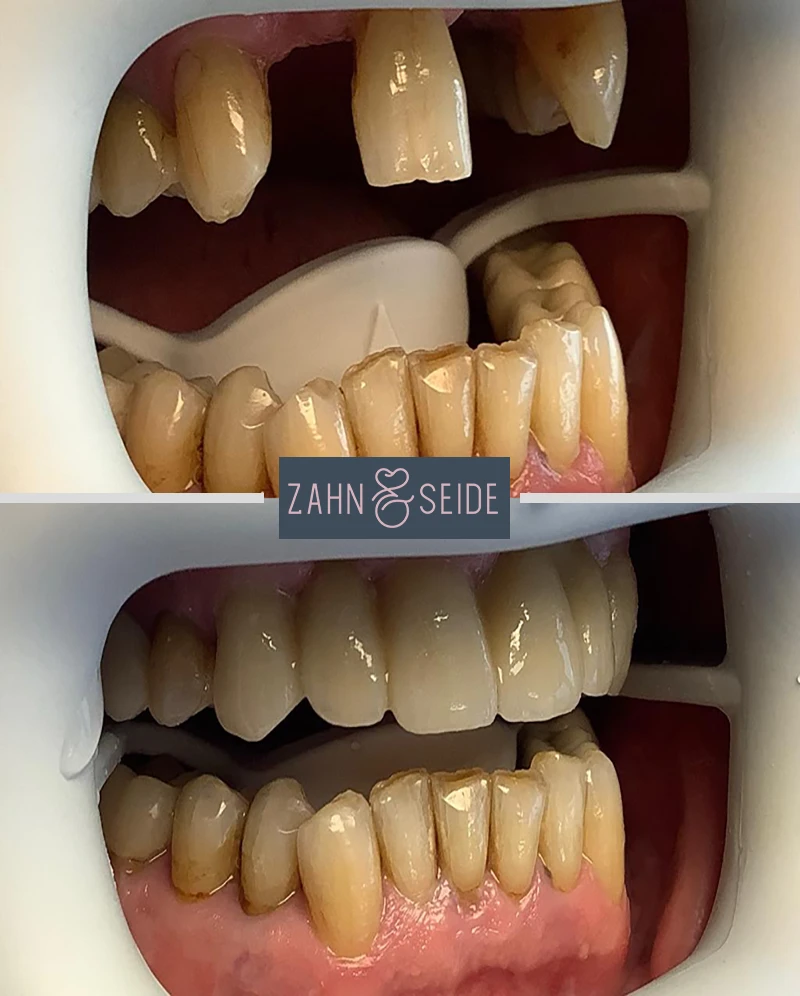 zahnarzt-kerpen-Vorher-Nachher-Implantatgetragener-Zahnersatz